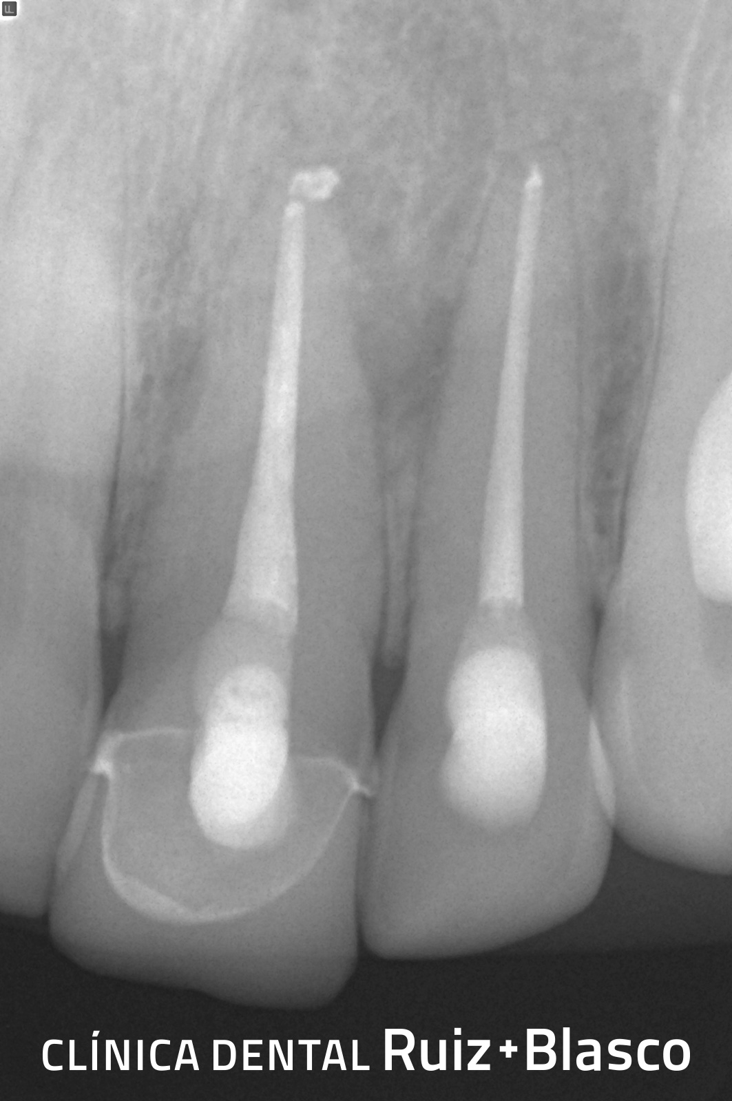 Endodoncia